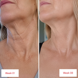 Before and after comparison of neck skin showing changes in texture and firmness