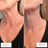 Before and after photos of neck skin showing smoother texture and fewer visible lines